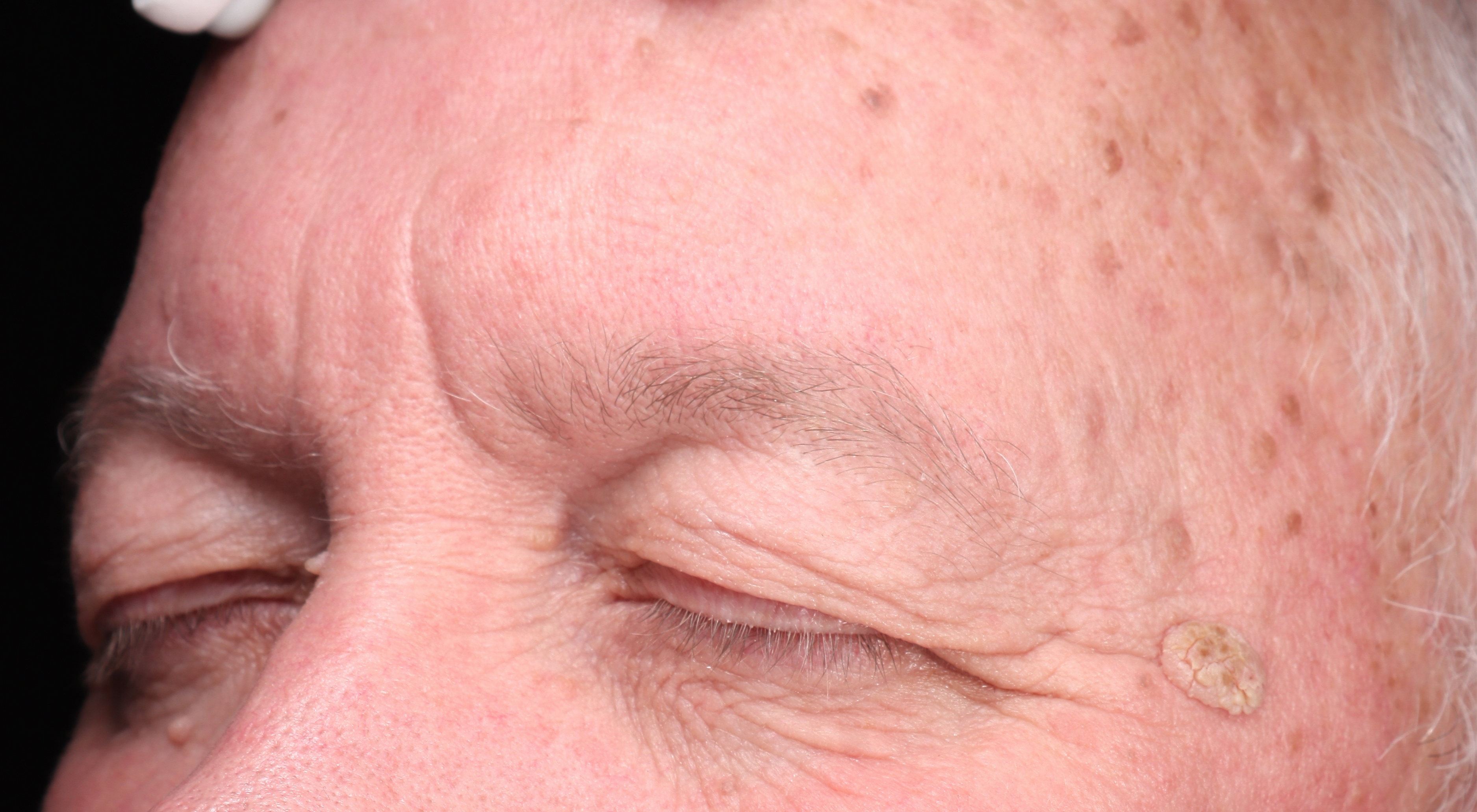 Before removal of lesion left temple in Sydney + Alma Hybrid for rejuvenation hyfrecation removal of Sebaceous keratosis