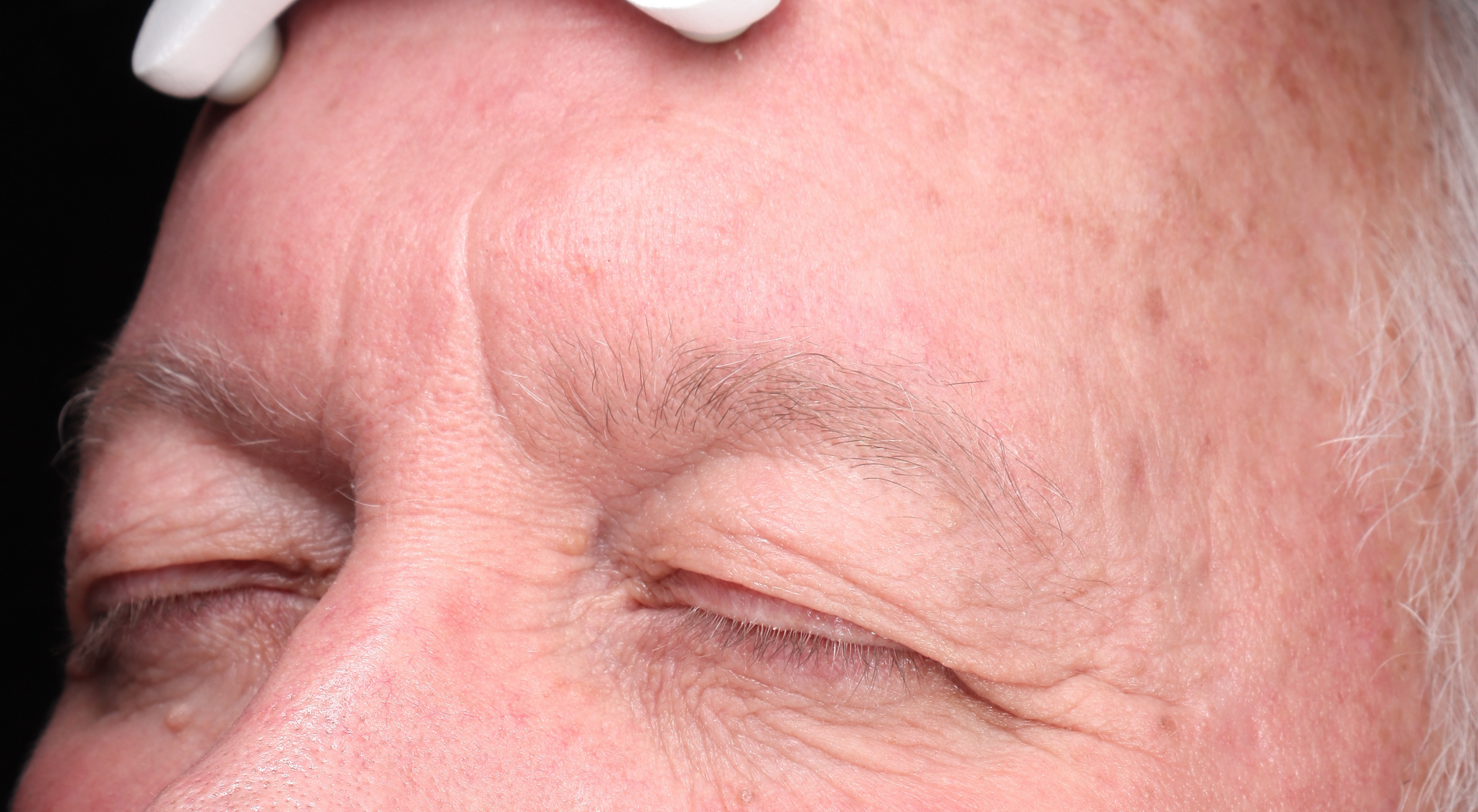 Before removal of lesion left temple in Sydney + Alma Hybrid for rejuvenation hyfrecation removal of Sebaceous keratosis