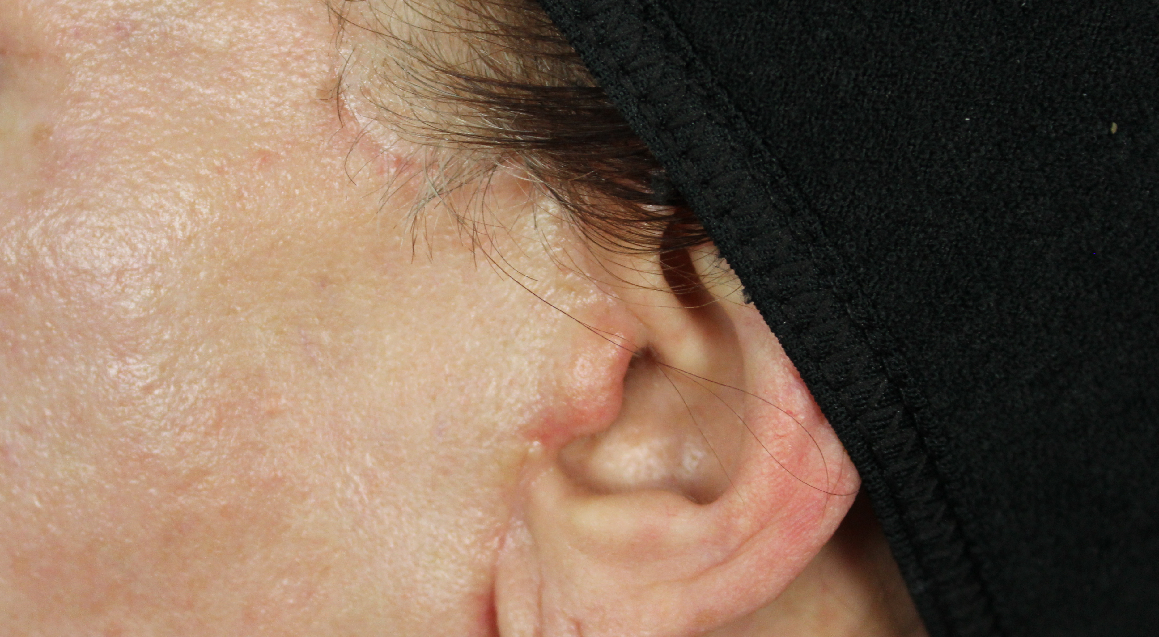 Face lift scar revision in Sydney Australia dermatologist Dr Natasha Cook Alma Hybrid CO2 fractional laser scar remodelling insulin transdermal delivery