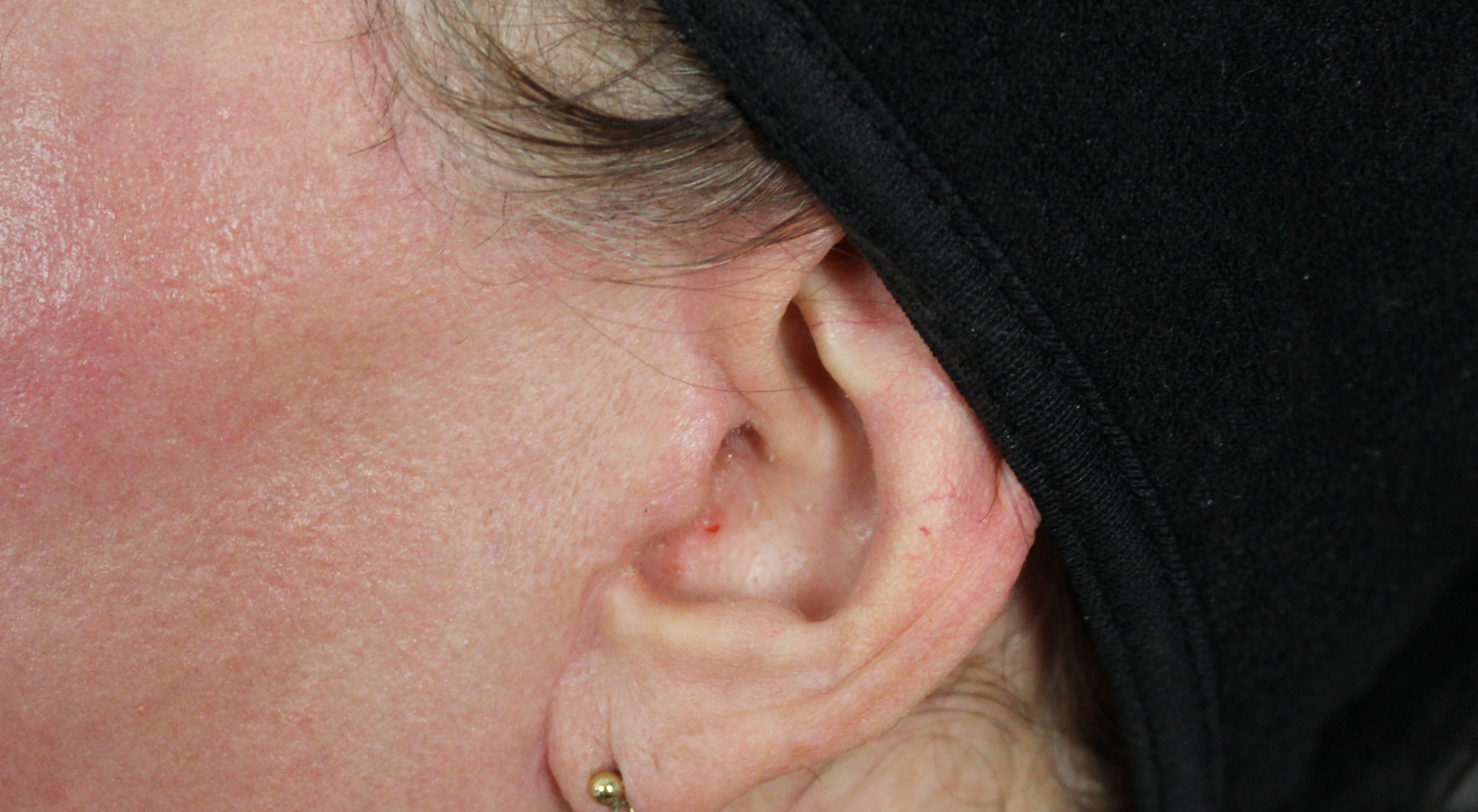 Face lift scar revision in Sydney Australia dermatologist Dr Natasha Cook Alma Hybrid CO2 fractional laser scar remodelling insulin transdermal delivery