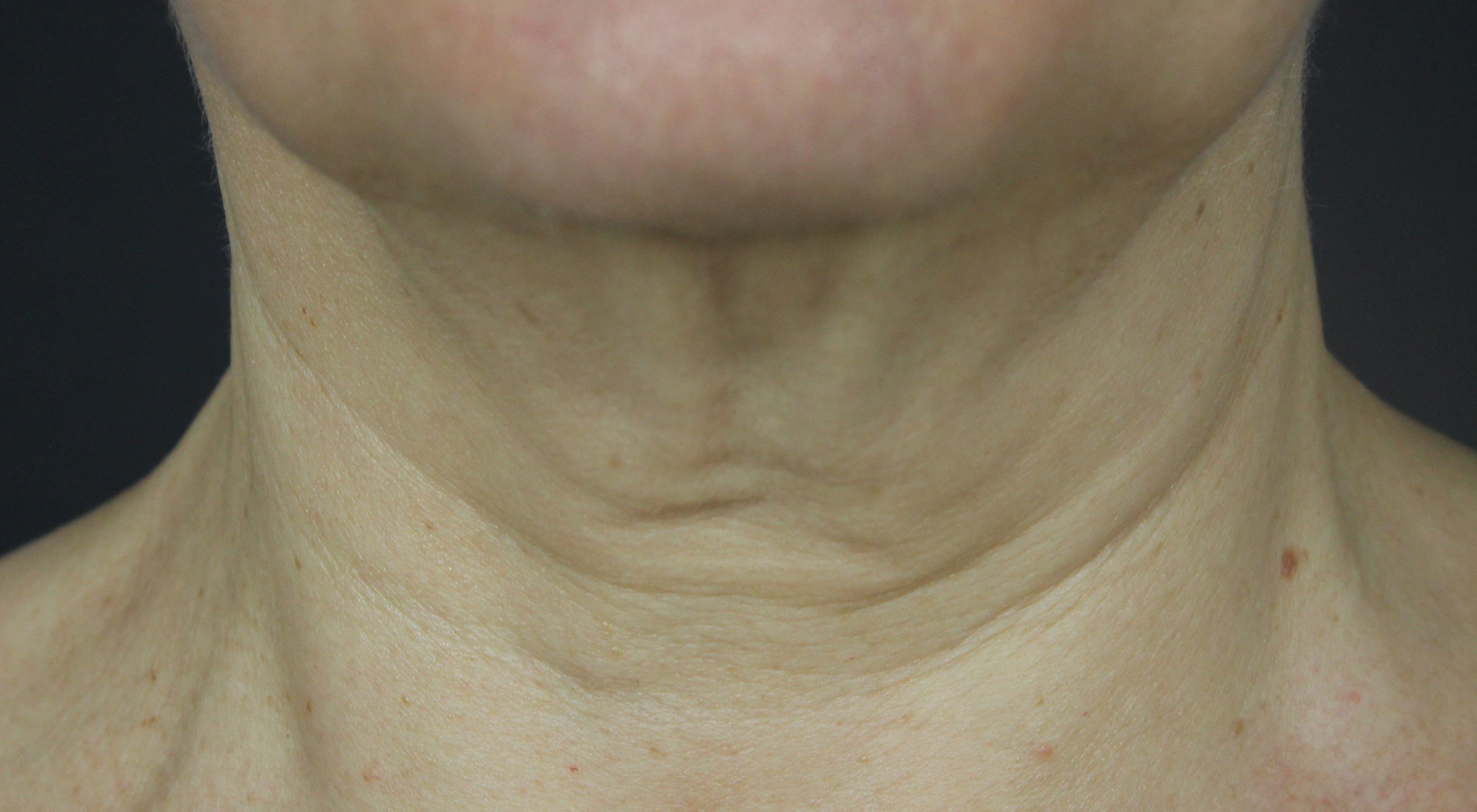 Before Morpheus8 Alma Hybrid for neck saggyness non surgical neck lift in Sydney The Face Bar by drnc