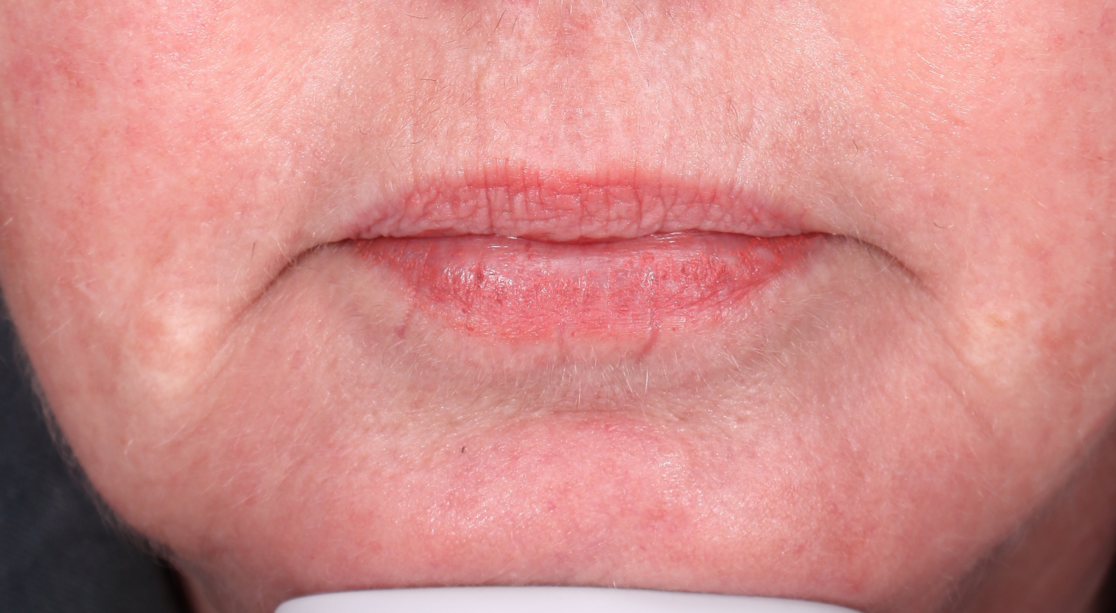 Before Perioral Alma Hybrid laser vermilionectomy. Nasolabial folds treatment in Sydney Dr Natasha Cook The Face Bar by dr.NC. Fine lines wrinkles sun damage