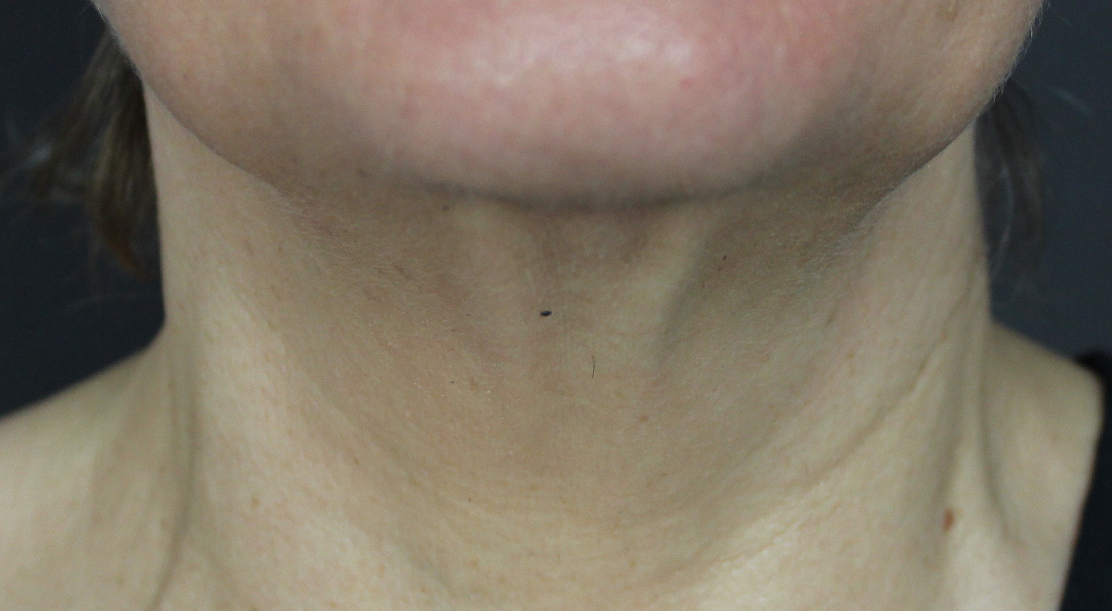 After non surgical laser neck lift