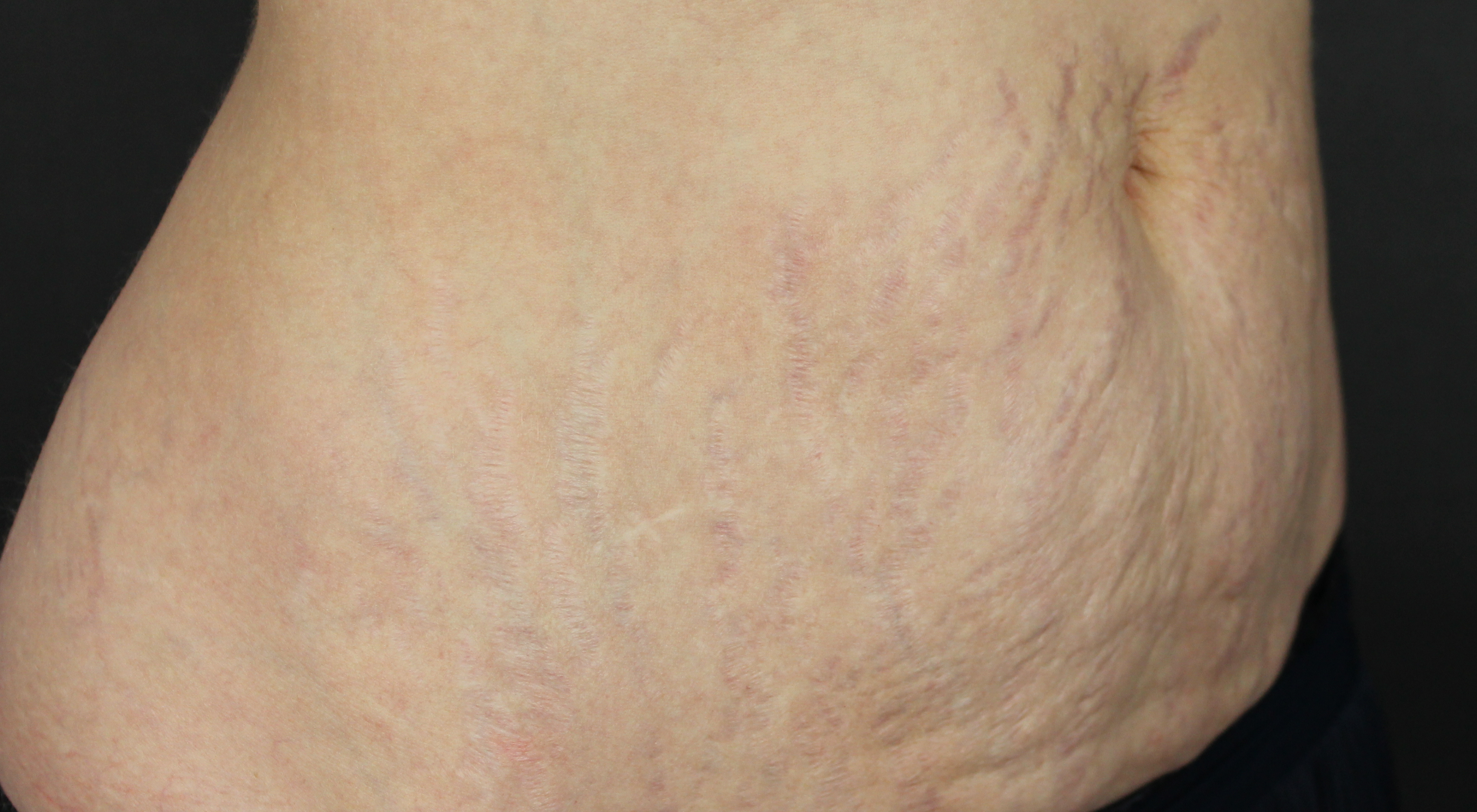 Before Morpheus8 Alma Hybrid Abdomen body treatment for stretchmarks and cellulite