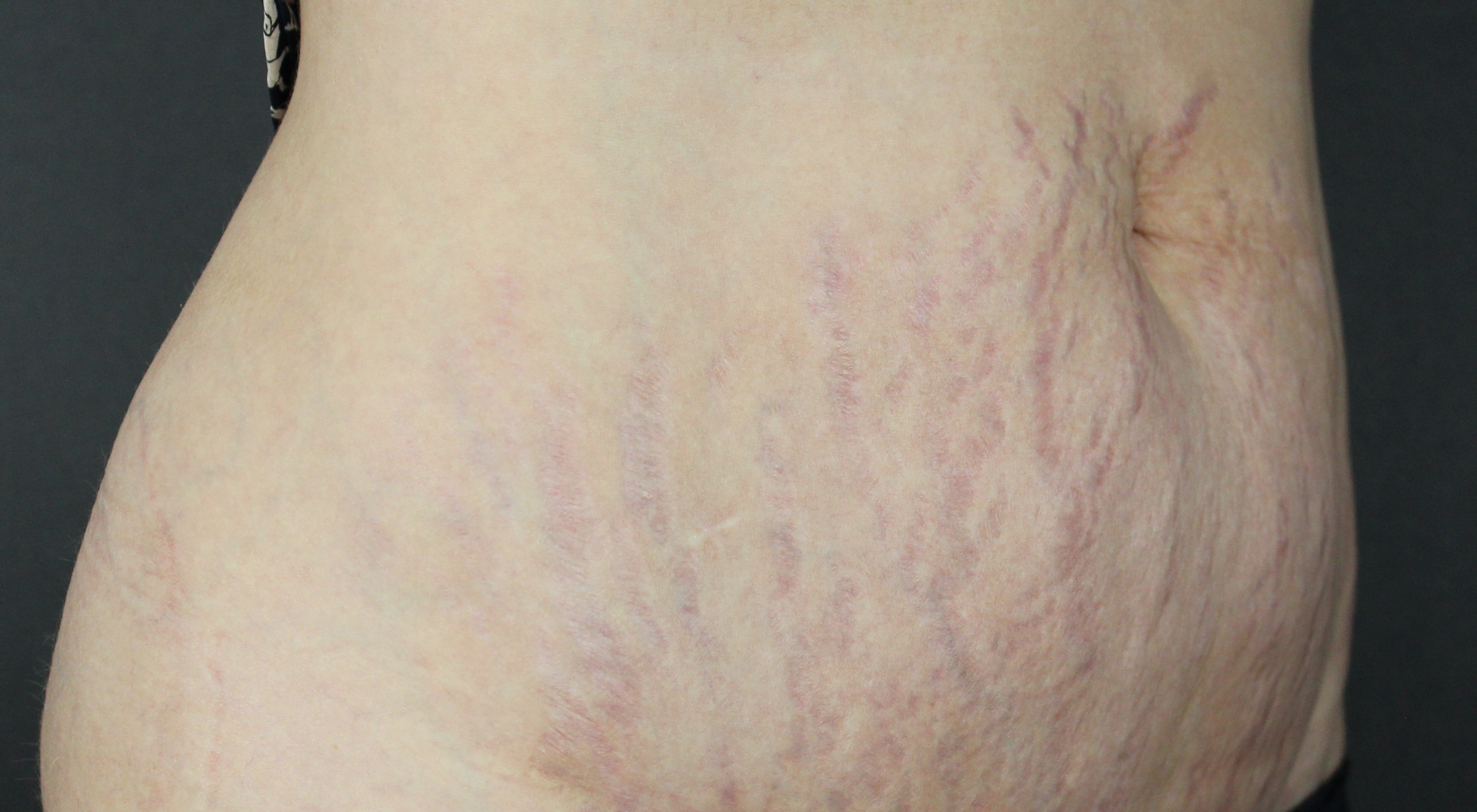 After Morpheus8 Alma Hybrid Abdomen body treatment for stretchmarks and cellulite The Face Bar by dr NC Darlinghurst