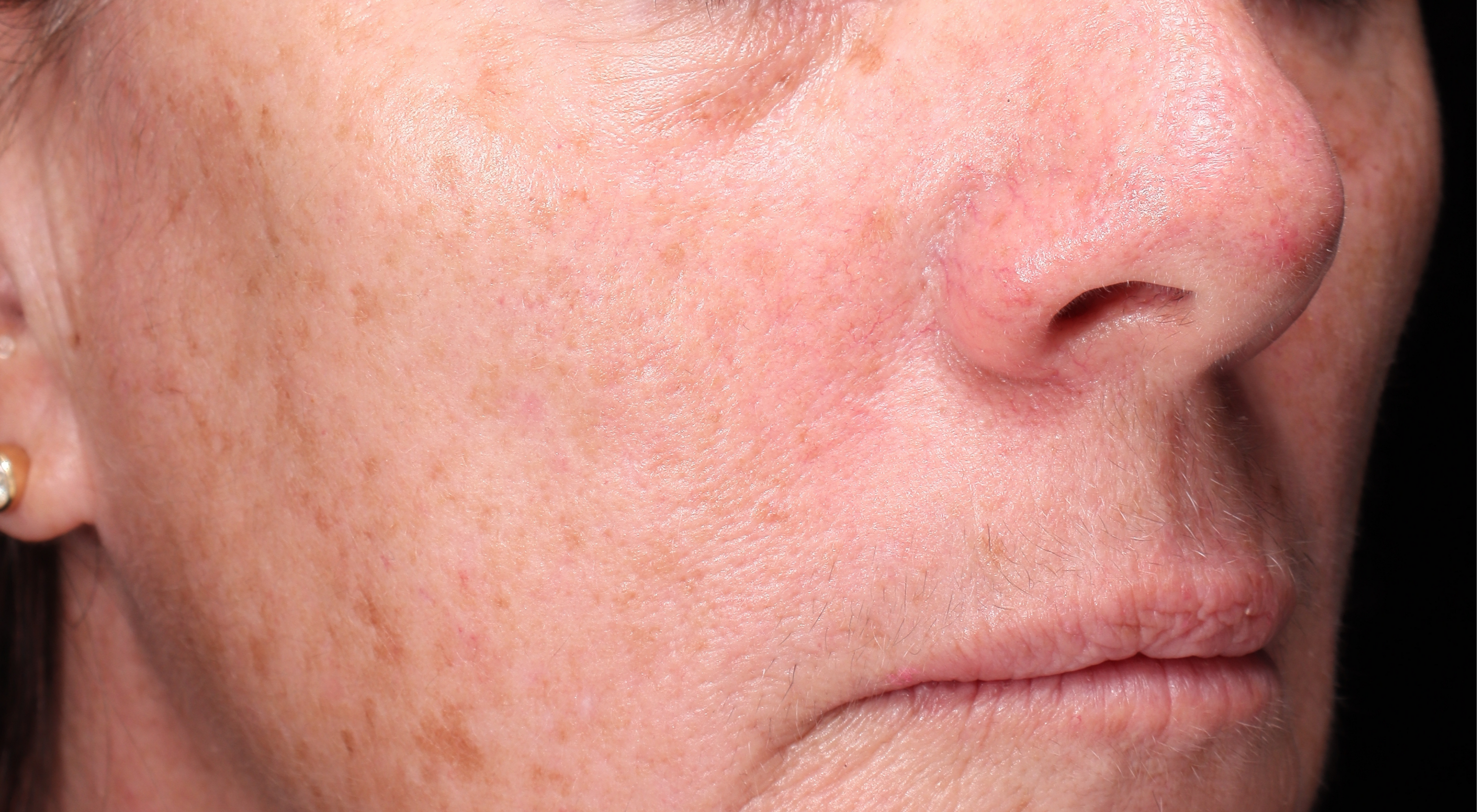 Before BBL Broad band light Sciton laser treatment Dr Natasha Cook Darlinghurst Dermatology. Pigmentation sun damage Laser in Sydney, Darlinghurst. The Face Bar by dr.NC