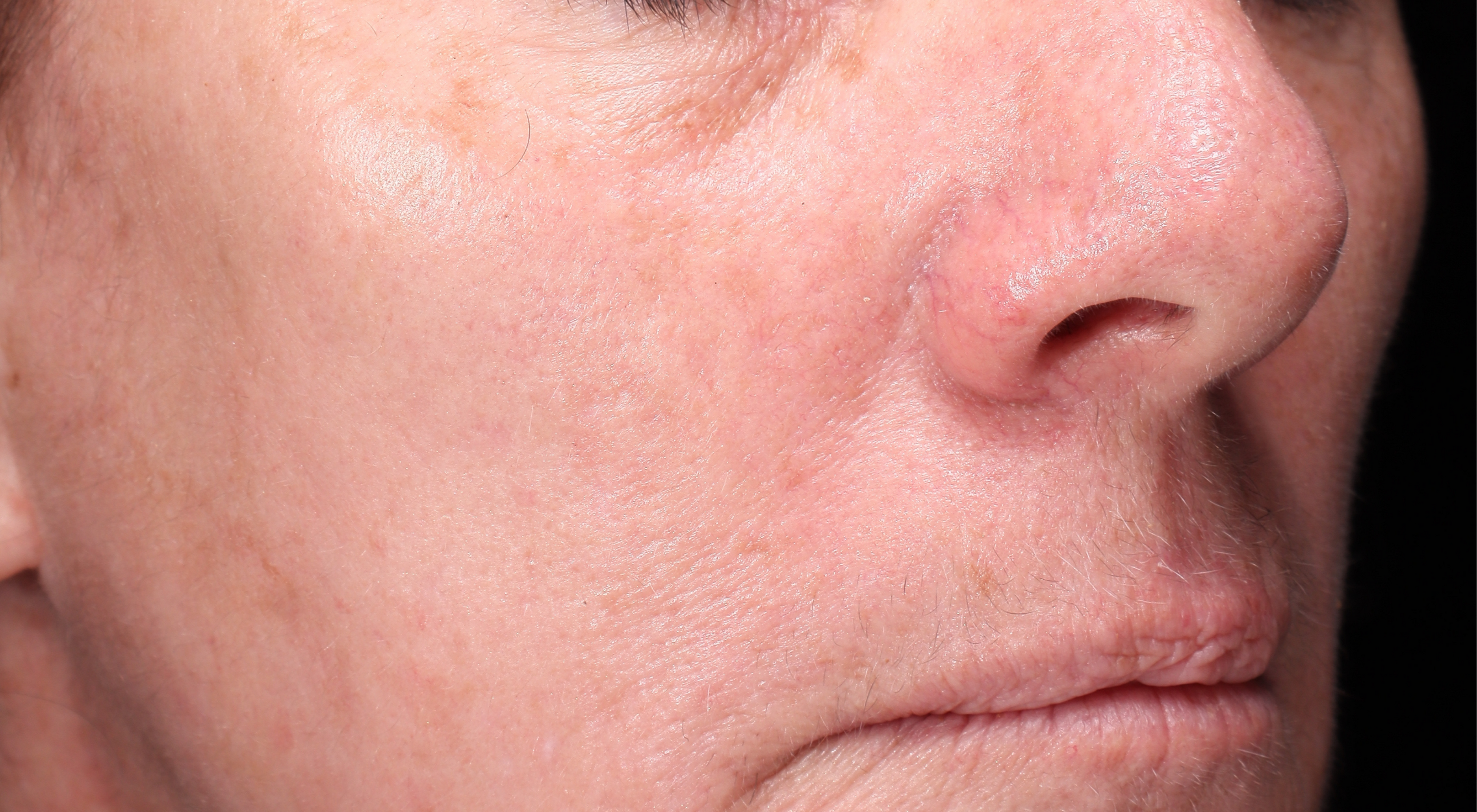 After BBL Broad band light Sciton laser treatment Dr Natasha Cook Darlinghurst Dermatology. Pigmentation sun damage Laser in Sydney, Darlinghurst. The Face Bar by dr.NC