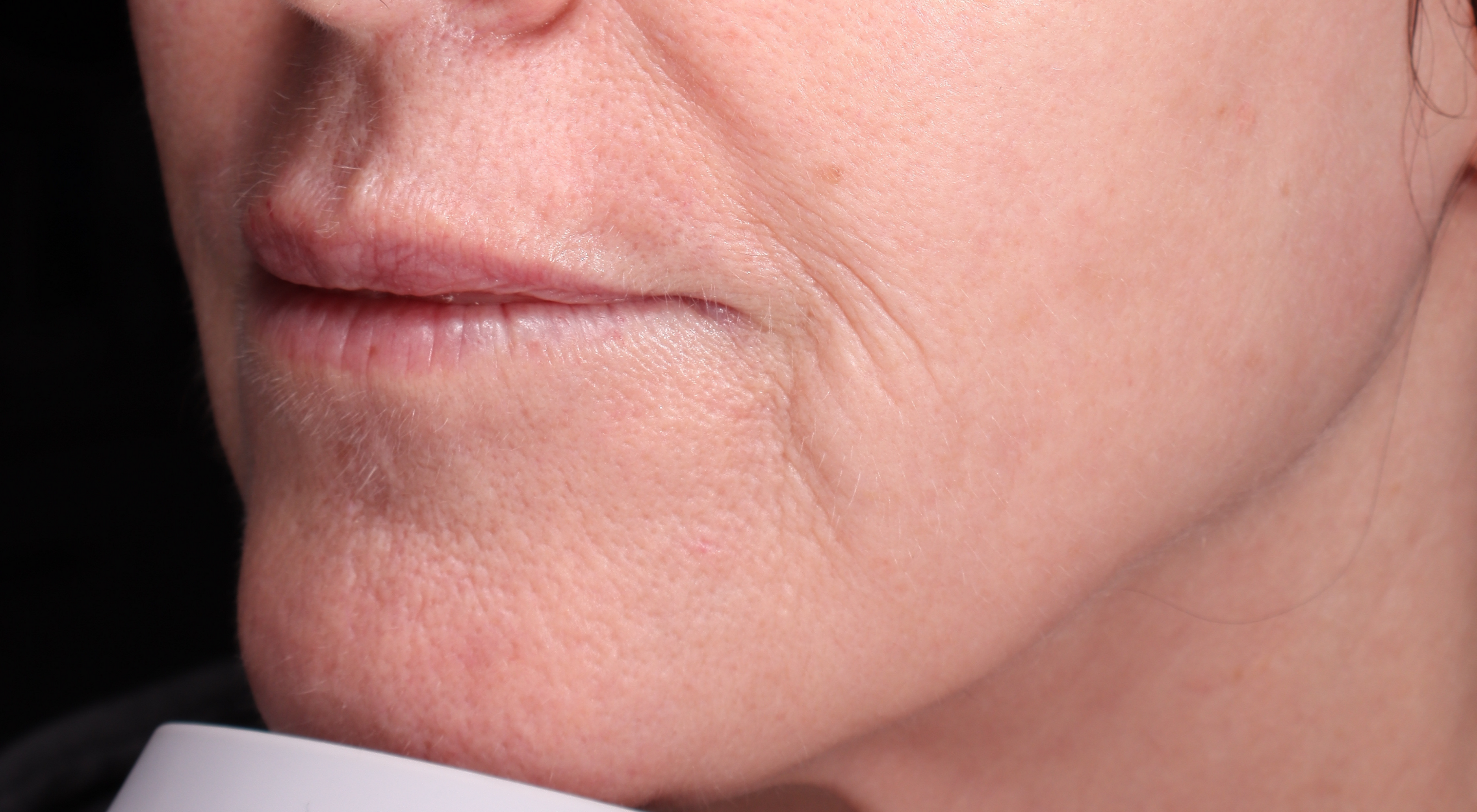 Before Perioral Alma Hybrid laser vermilionectomy. Nasolabial folds treatment in Sydney Dr Natasha Cook The Face Bar by dr.NC. Fine lines wrinkles sun damage