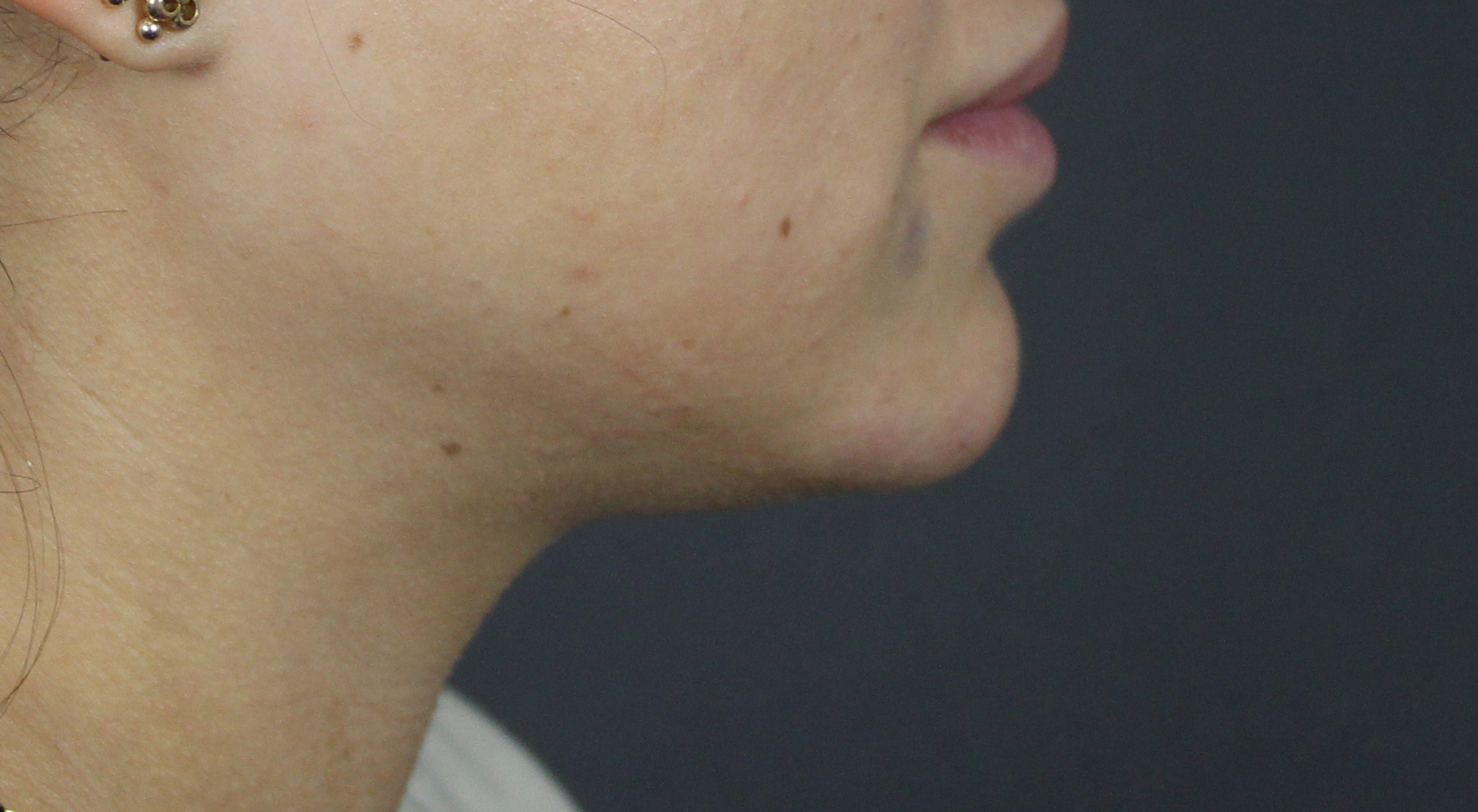 Before Belkyra fat dissolving injections with Dr Natasha Cook dermatologist under chin submittal fat jawline contouring in Sydney