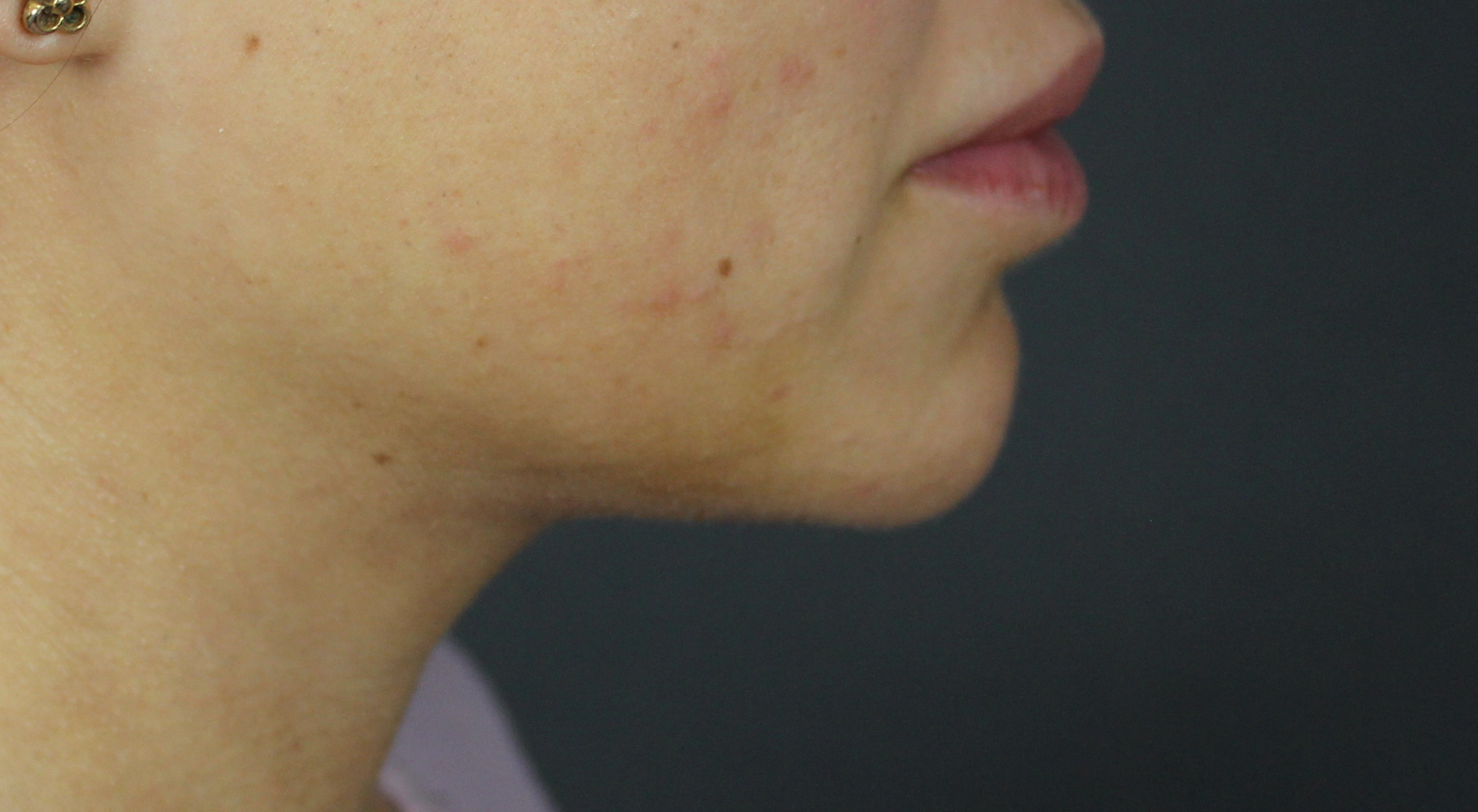 After Belkyra fat dissolving injections with Dr Natasha Cook dermatologist under chin submittal fat jawline contouring in Sydney