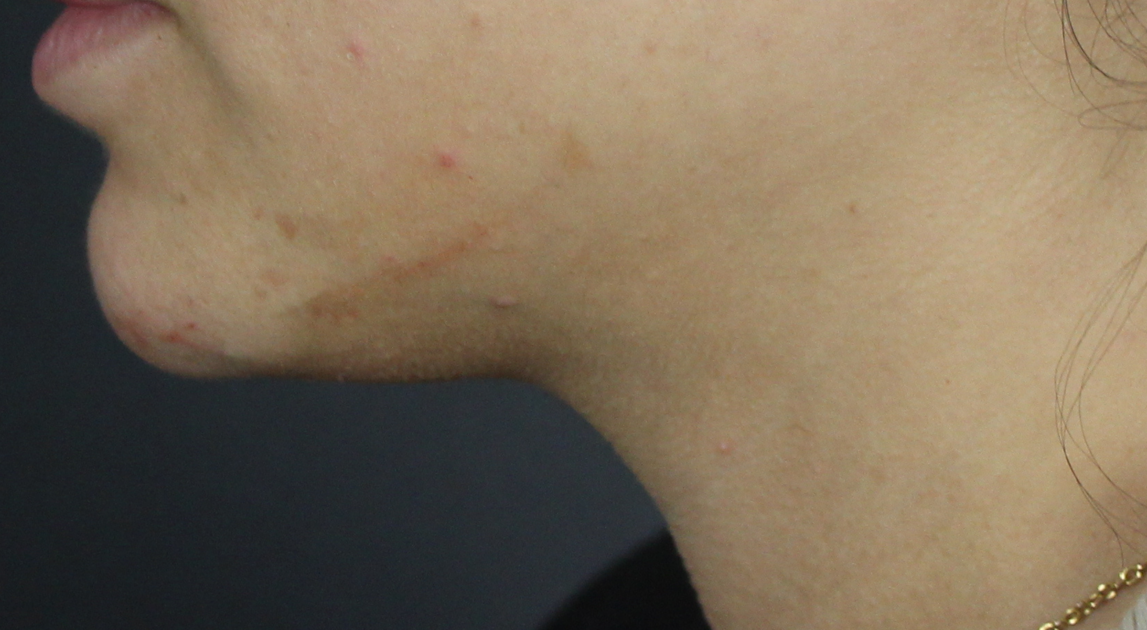 Before Belkyra fat dissolving injections with Dr Natasha Cook dermatologist under chin submittal fat jawline contouring in Sydney