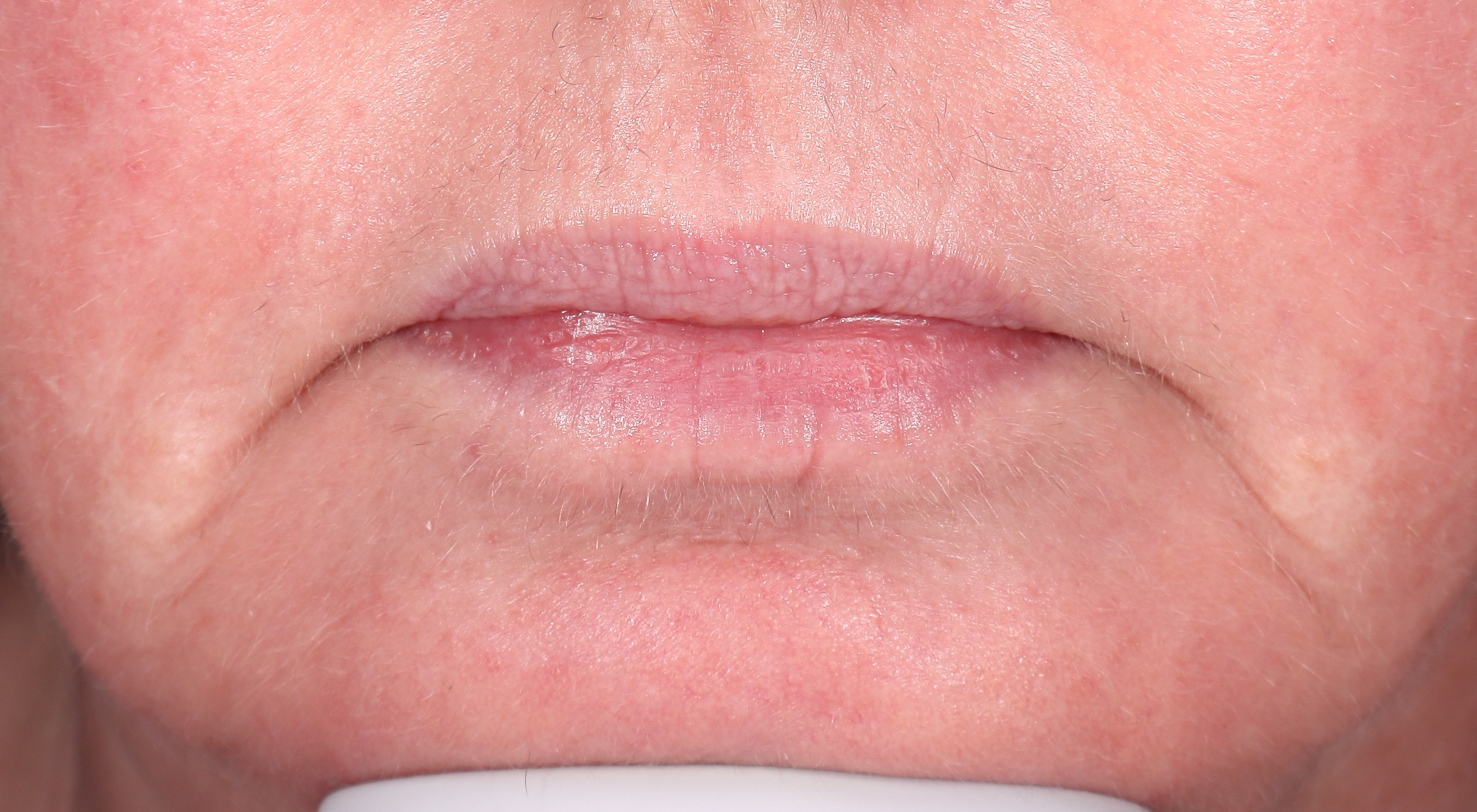 After Perioral Alma Hybrid laser vermilionectomy. Nasolabial folds treatment in Sydney Dr Natasha Cook The Face Bar by dr.NC. Fine lines wrinkles sun damage