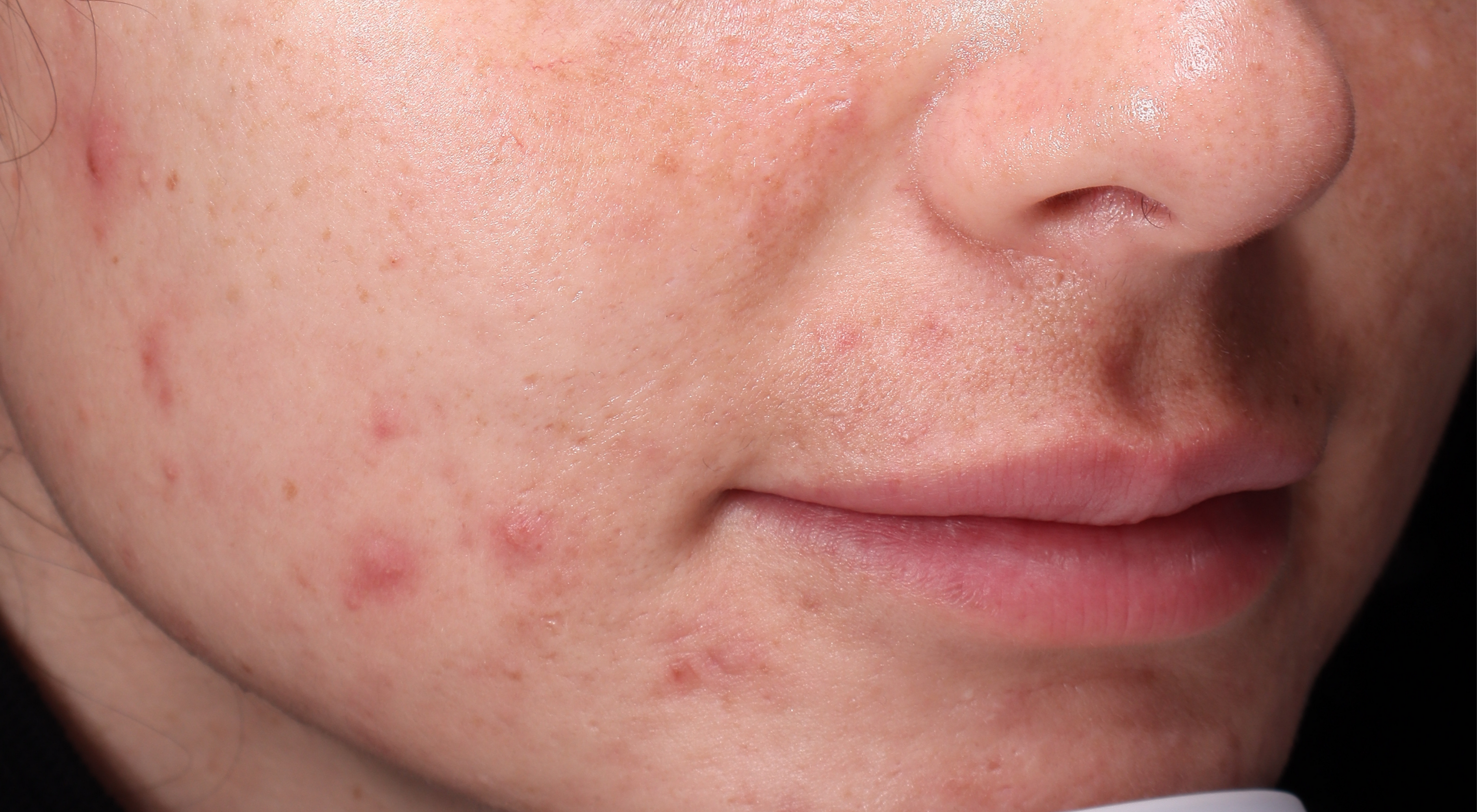 Acne treatment by dermatologist dr Natasha cook hydra facial laser genesis congestion Sydney face bar by dr.NC