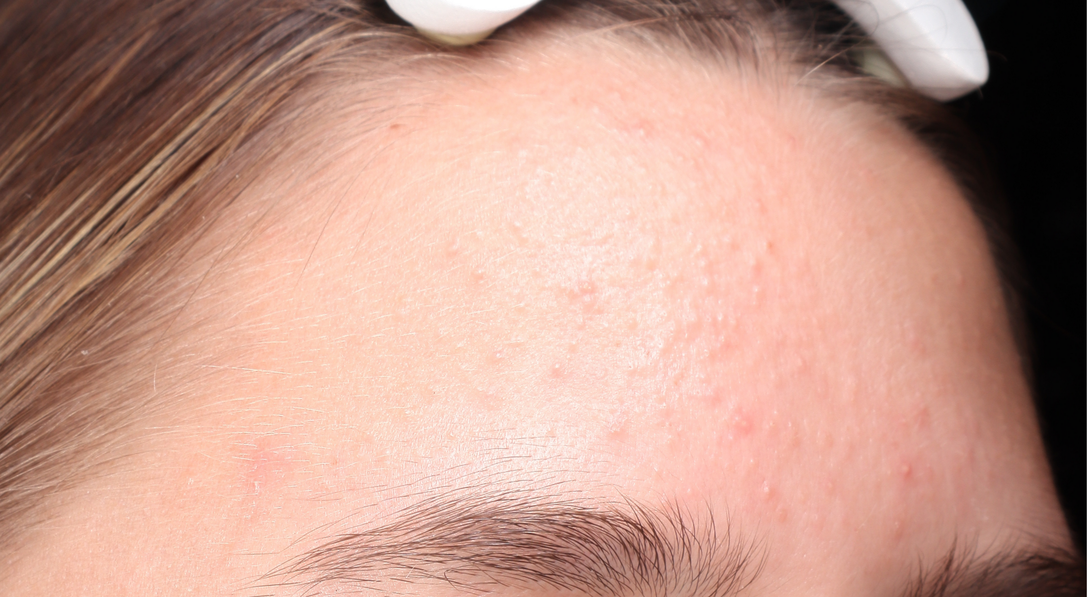 Congestion blackheads whiteheads on forehead