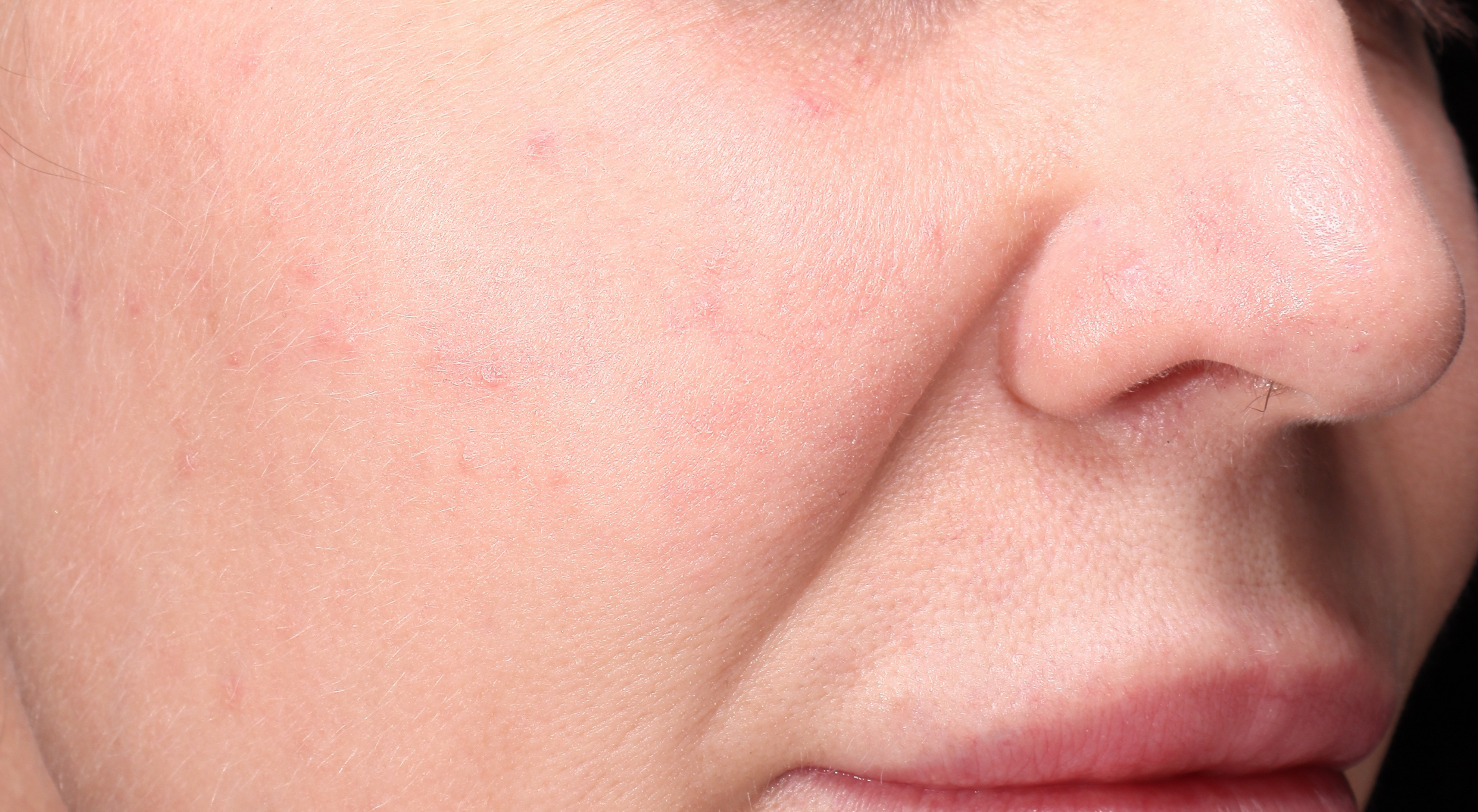 After treatment for rosacea redness flushing with Dr Natasha Cook Dermatologist Sydney vascular laser Cutera excel V+ Laser Genesis capillaries veins . Sydney Face Bar by dr.NC