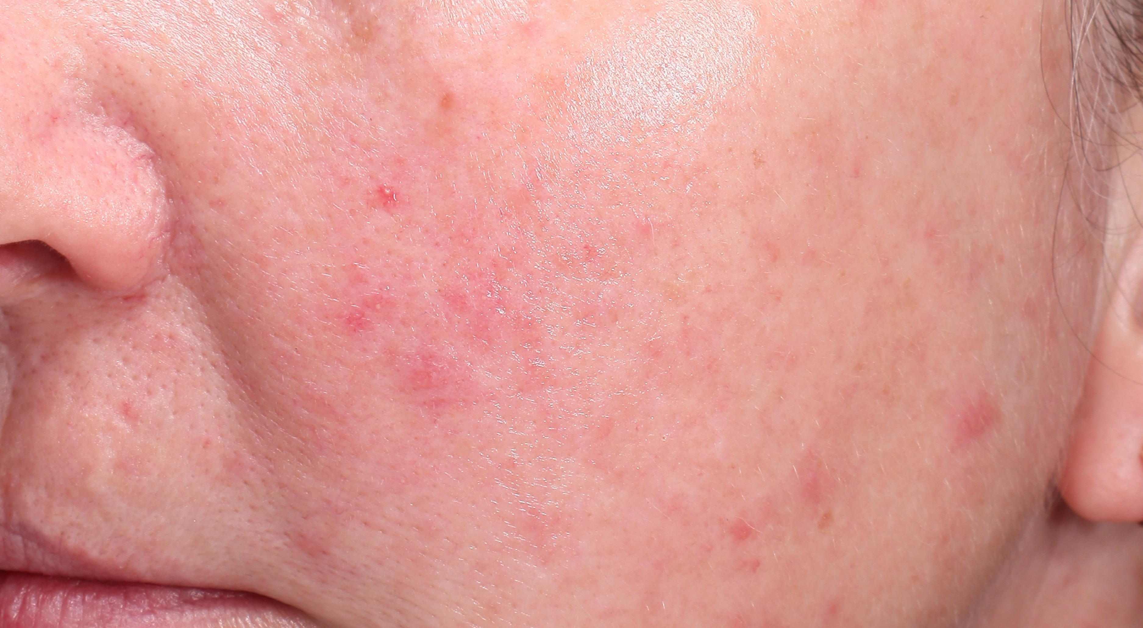 Before treatment for rosacea redness flushing nose capillaries telangiectasis with Dr Natasha Cook Dermatologist Sydney vascular laser Cutera excel V+ Laser Genesis capillaries veins . Sydney Face Bar by dr.NC