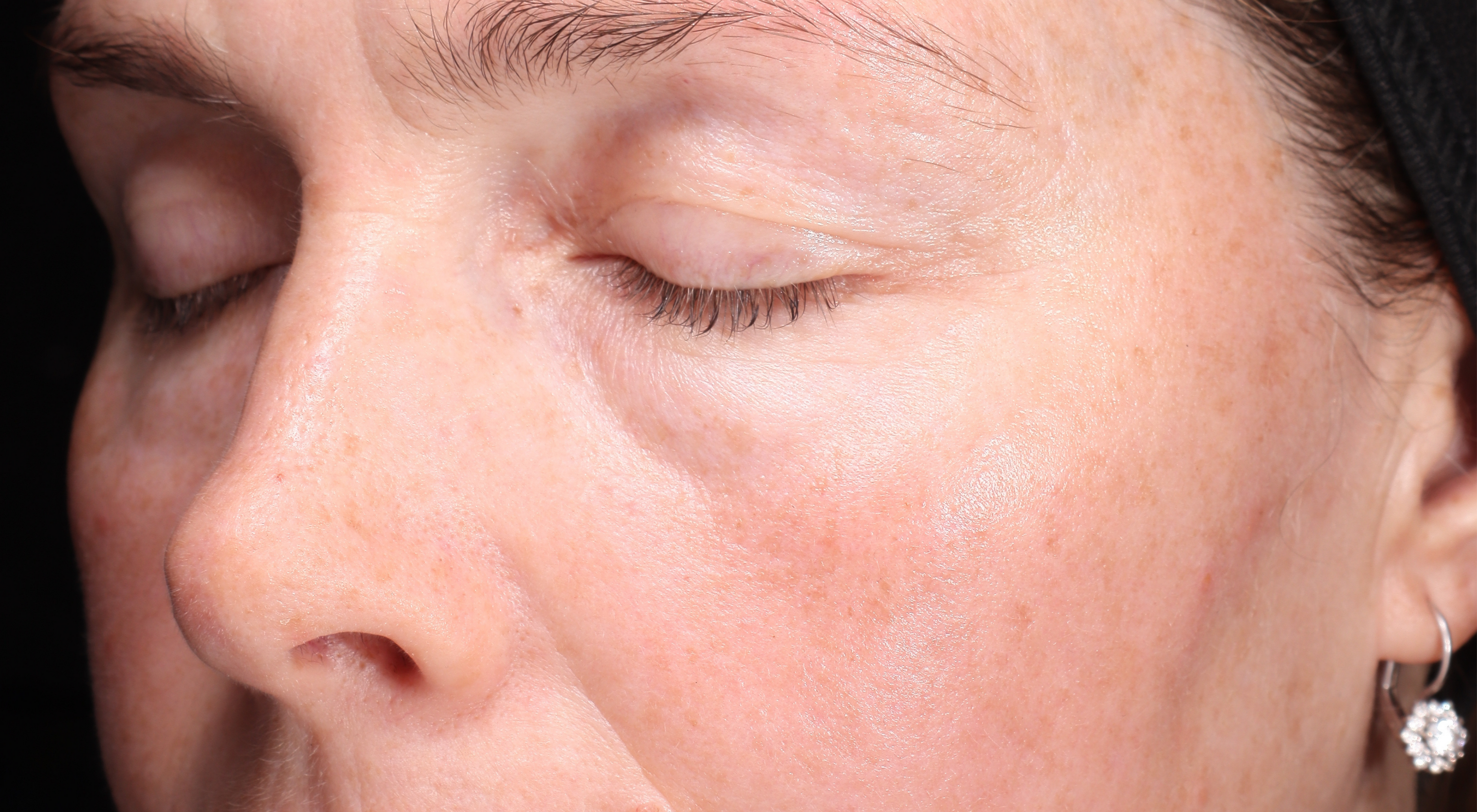 Before Antiageing laser treatment Dr Natasha Cook Darlinghurst Dermatology. Rejuvenated under eyes periorbital area. Alma Hybrid CO2 Laser in Sydney, Darlinghurst. The Face Bar by dr.NC