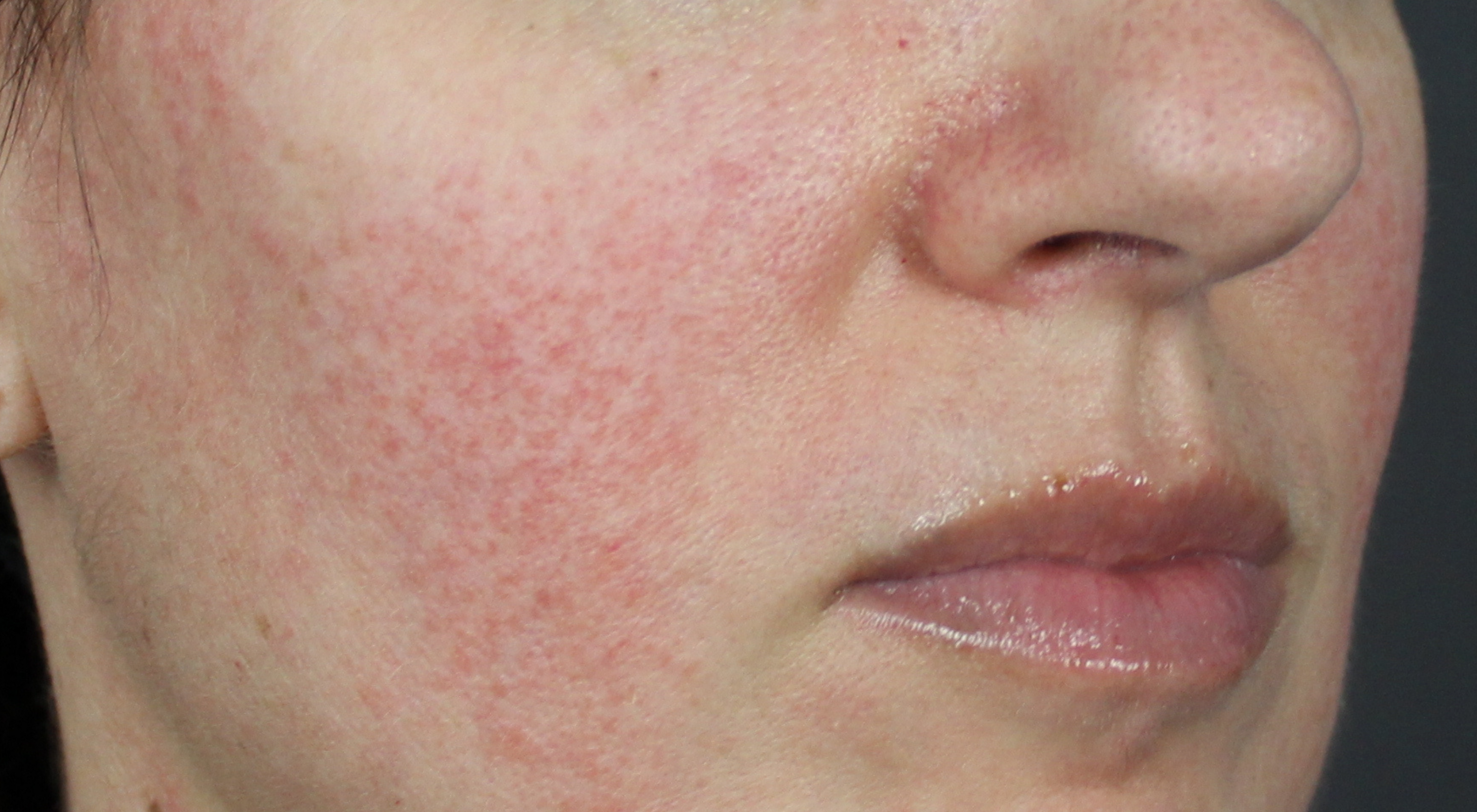 Before treatment for rosacea redness flushing nose capillaries telangiectasis with Dr Natasha Cook Dermatologist Sydney vascular laser Cutera excel V+ Laser Genesis capillaries veins . Sydney Face Bar by dr.NC