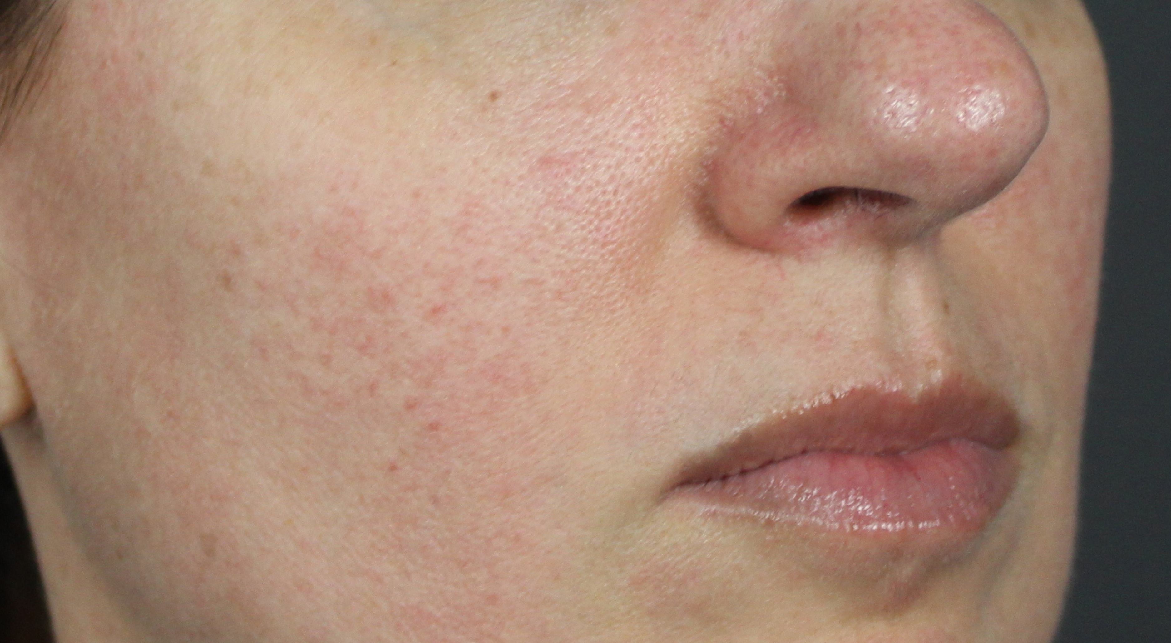 After treatment for rosacea redness flushing nose capillaries telangiectasis with Dr Natasha Cook Dermatologist Sydney vascular laser Cutera excel V+ Laser Genesis capillaries veins . Sydney Face Bar by dr.NC