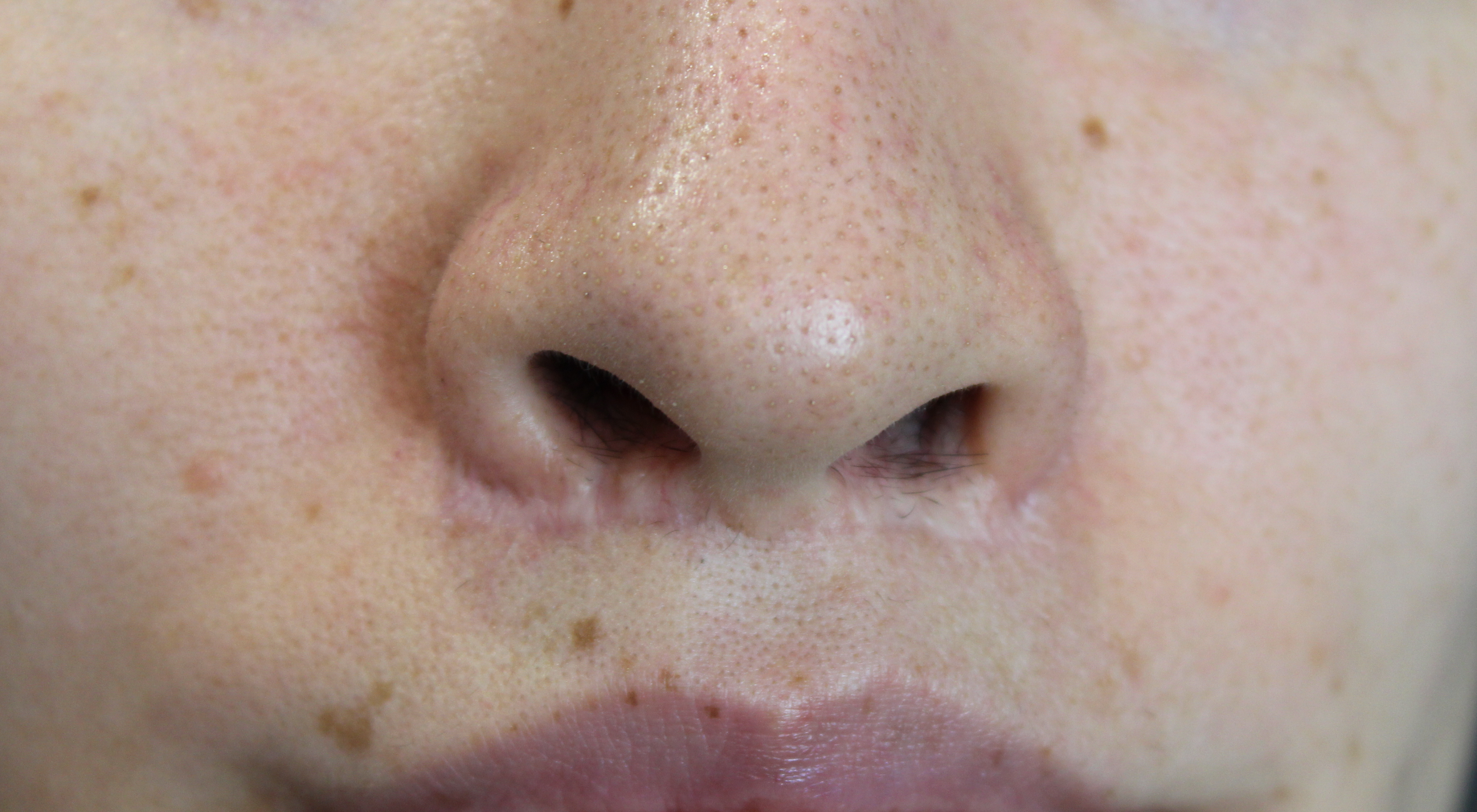 Before profractional laser treatment to surgical scar under nose from lip lift