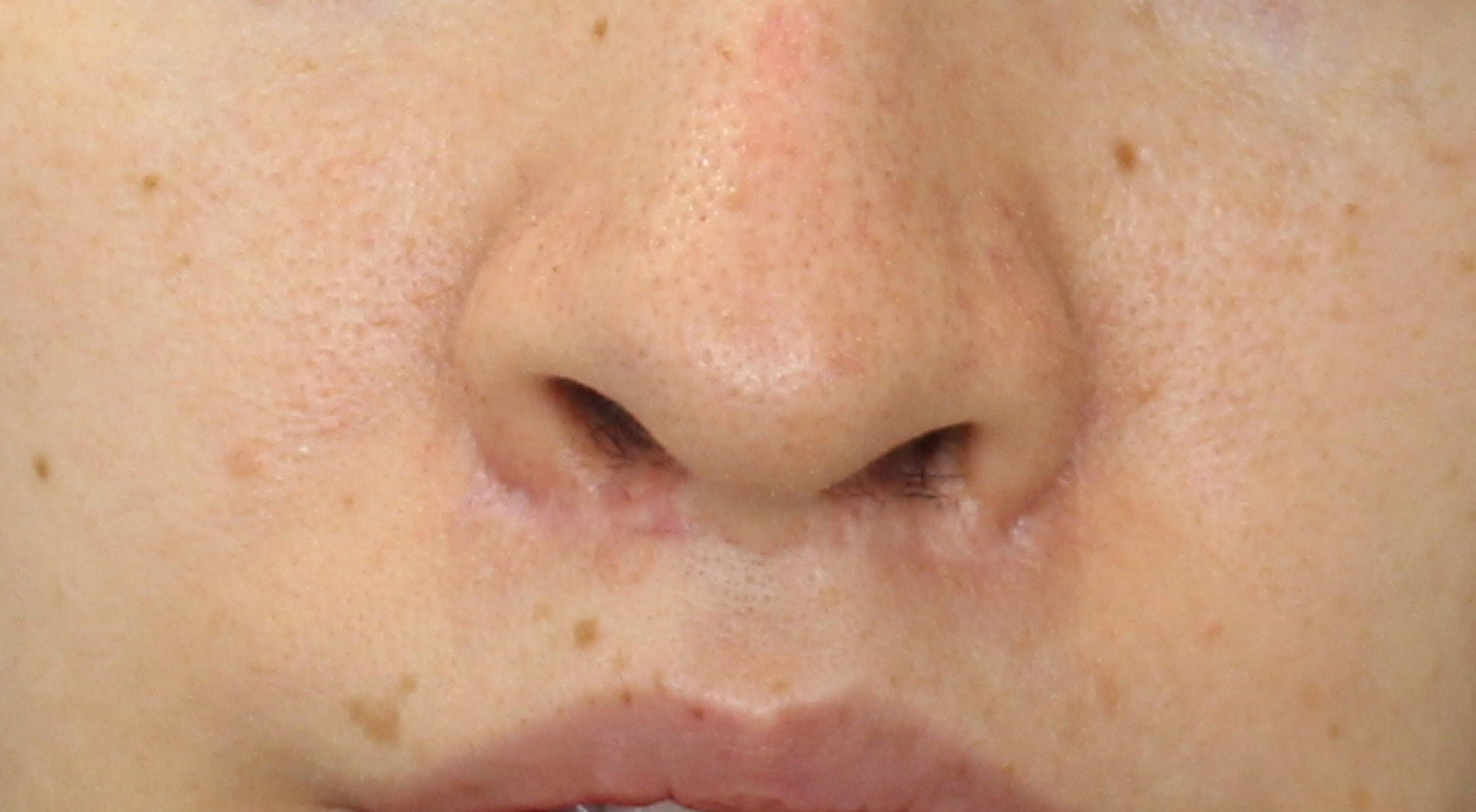 After profractional laser treatment to surgical scar under nose from lip lift