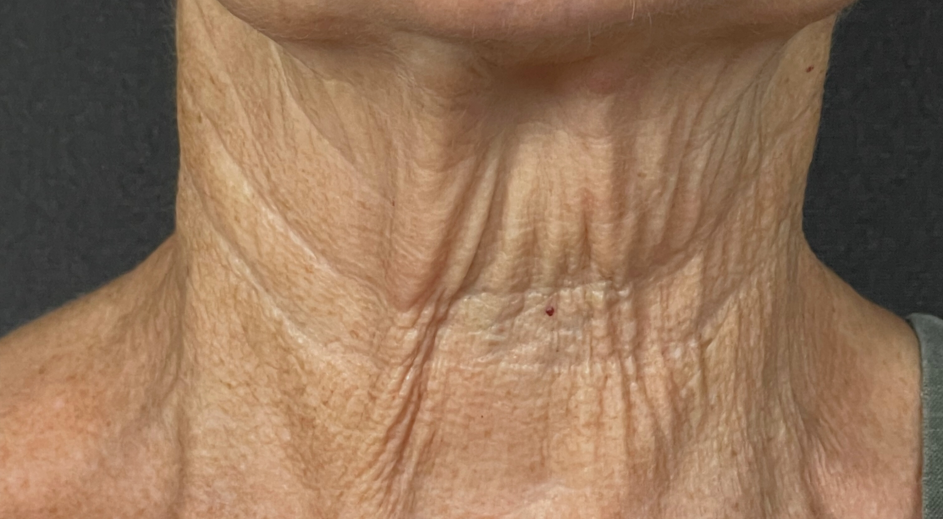 After treatment to neck loose saggy skin profhilo bioremodellator Alma Hybrid neck BBL with dermatologist Dr Natasha Cook in Sydney