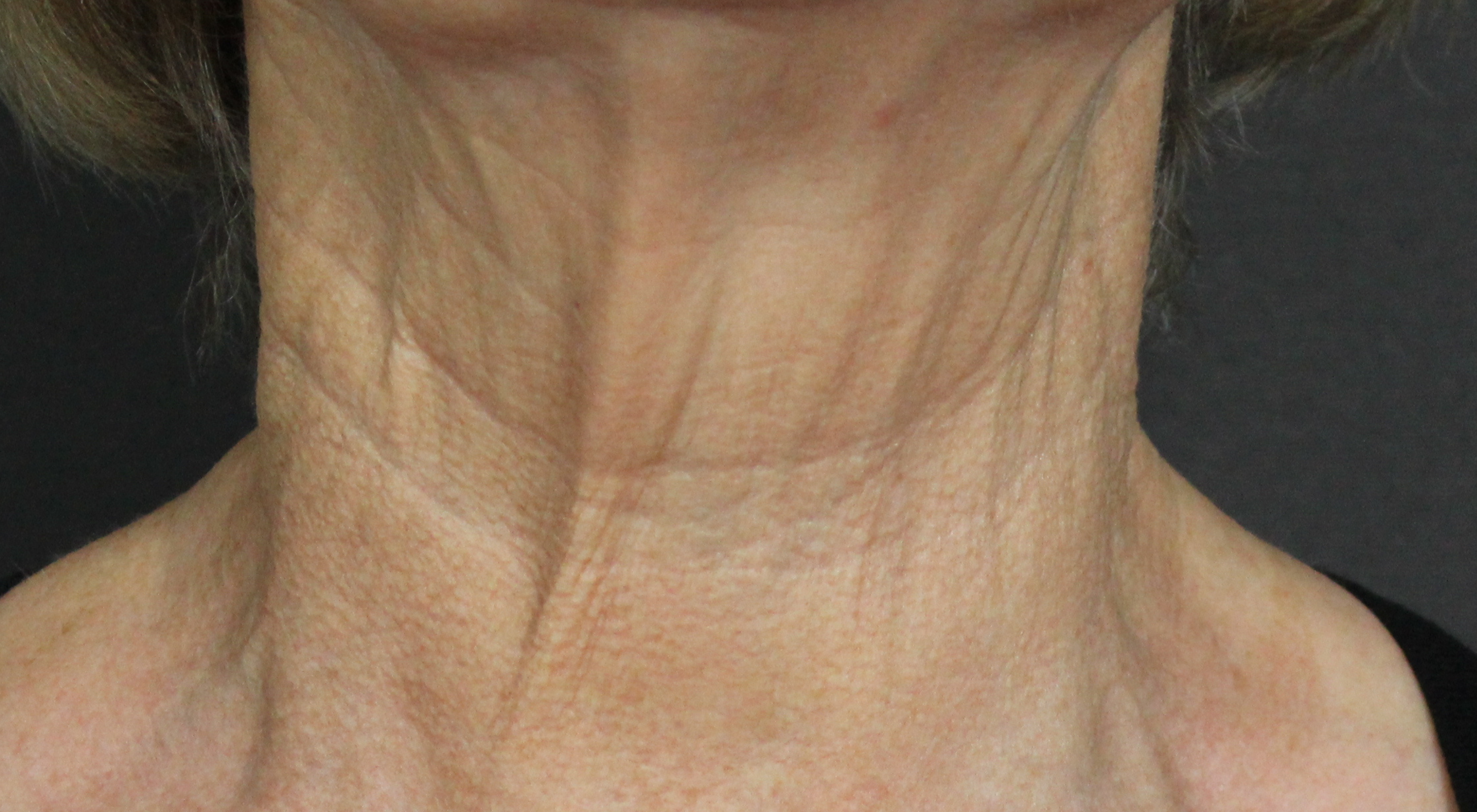 After treatment to neck loose saggy skin profhilo bioremodellator Alma Hybrid neck BBL with dermatologist Dr Natasha Cook in Sydney