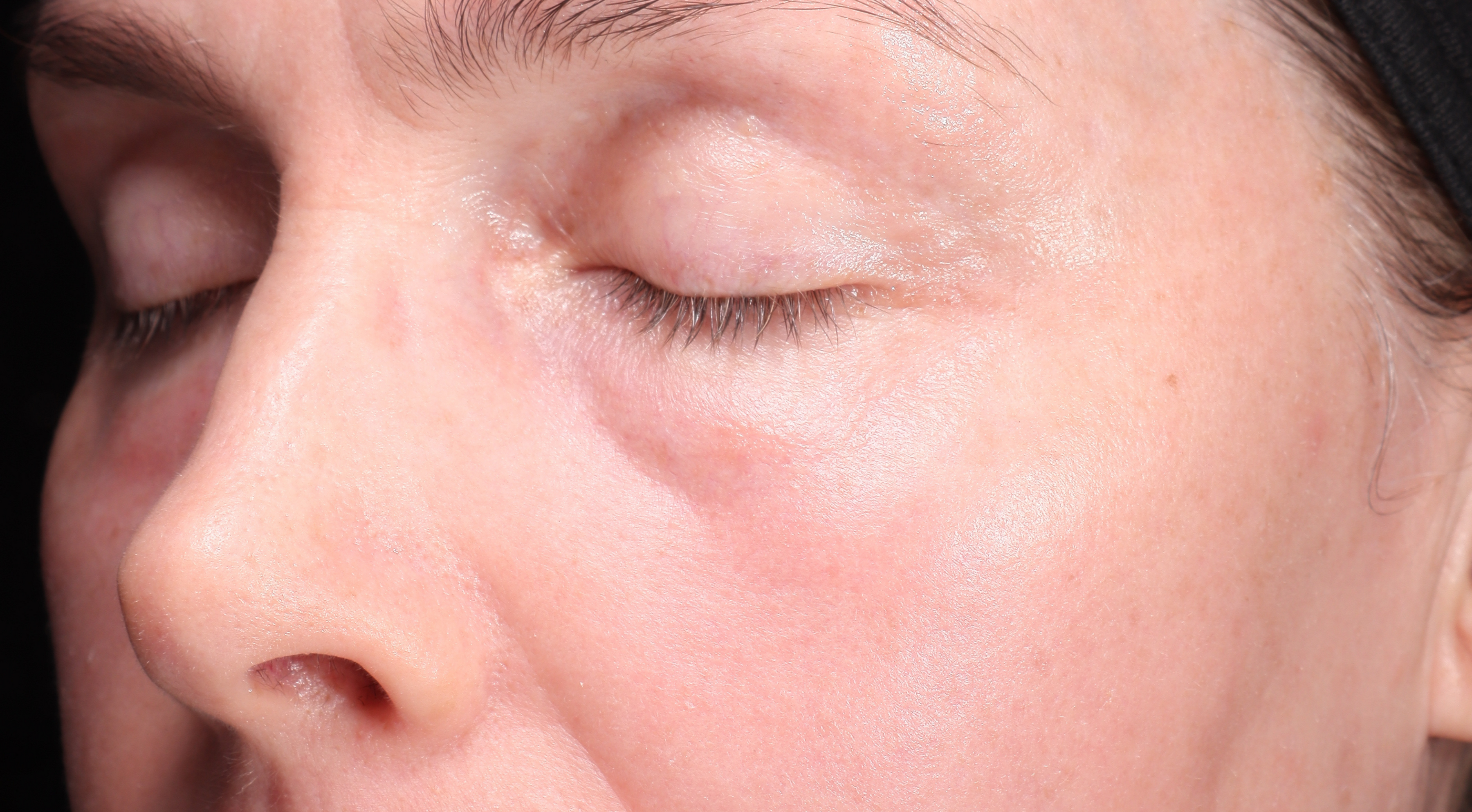 After Antiageing laser treatment Dr Natasha Cook Darlinghurst Dermatology. Rejuvenated under eyes periorbital area. Alma Hybrid CO2 Laser in Sydney, Darlinghurst. The Face Bar by dr.NC Non-surgical eyelift laser treatment in Sydney