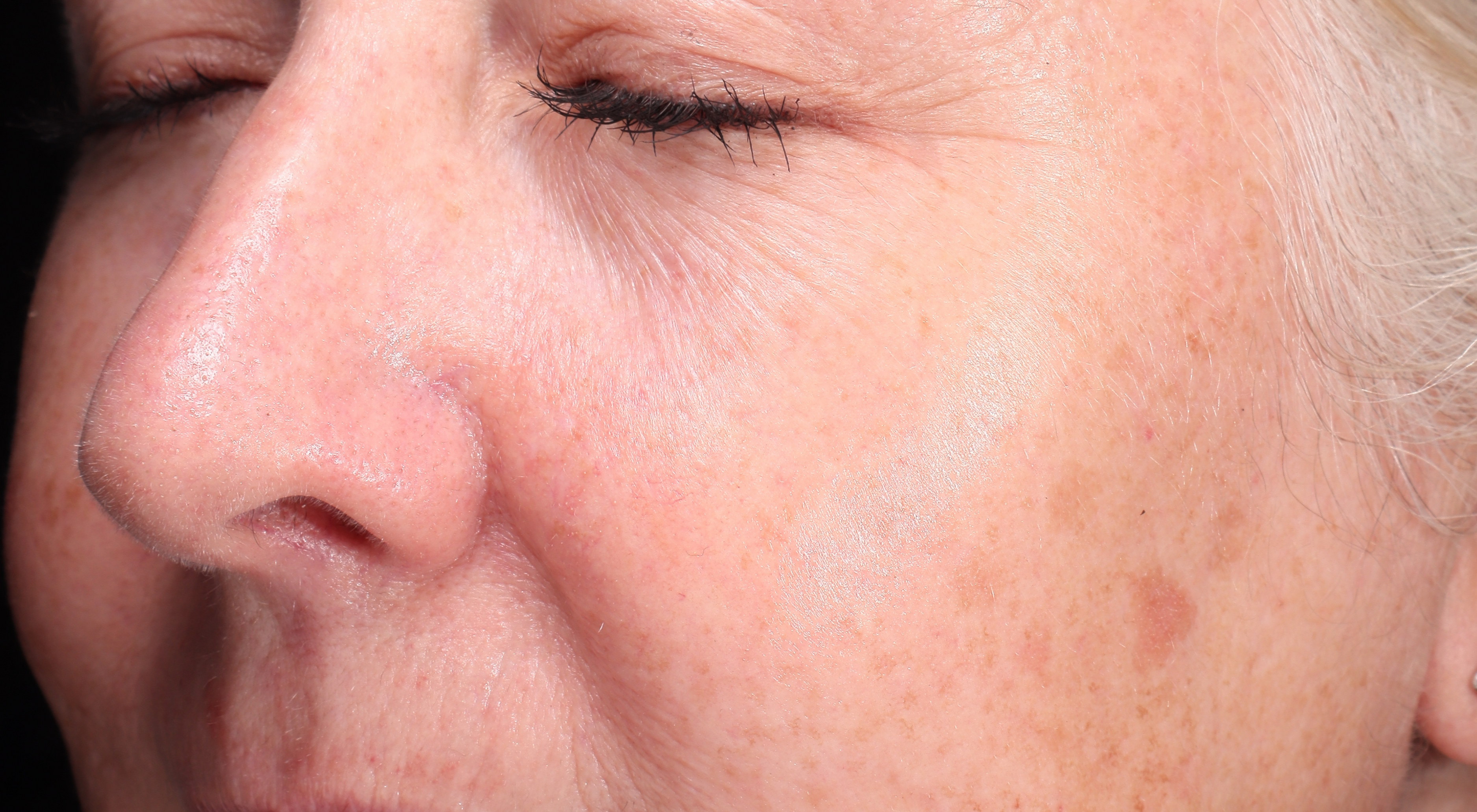 Before Antiageing laser treatment Dr Natasha Cook Darlinghurst Dermatology. Rejuvenated under eyes periorbital area. Alma Hybrid CO2 Laser in Sydney, Darlinghurst. The Face Bar by dr.NC