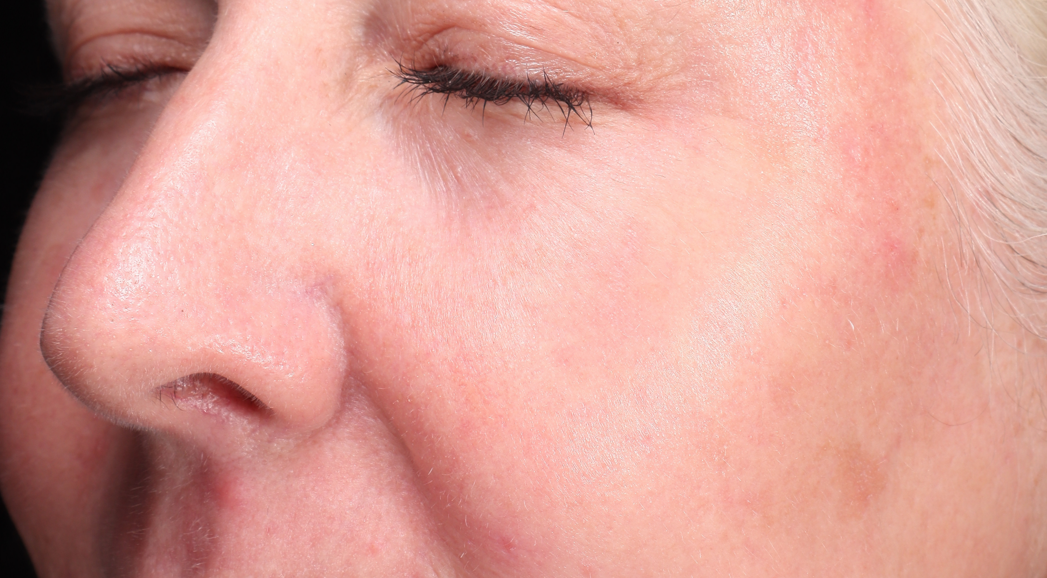 After Antiageing laser treatment Dr Natasha Cook Darlinghurst Dermatology. Rejuvenated under eyes periorbital area. Alma Hybrid CO2 Laser in Sydney, Darlinghurst. The Face Bar by dr.NC