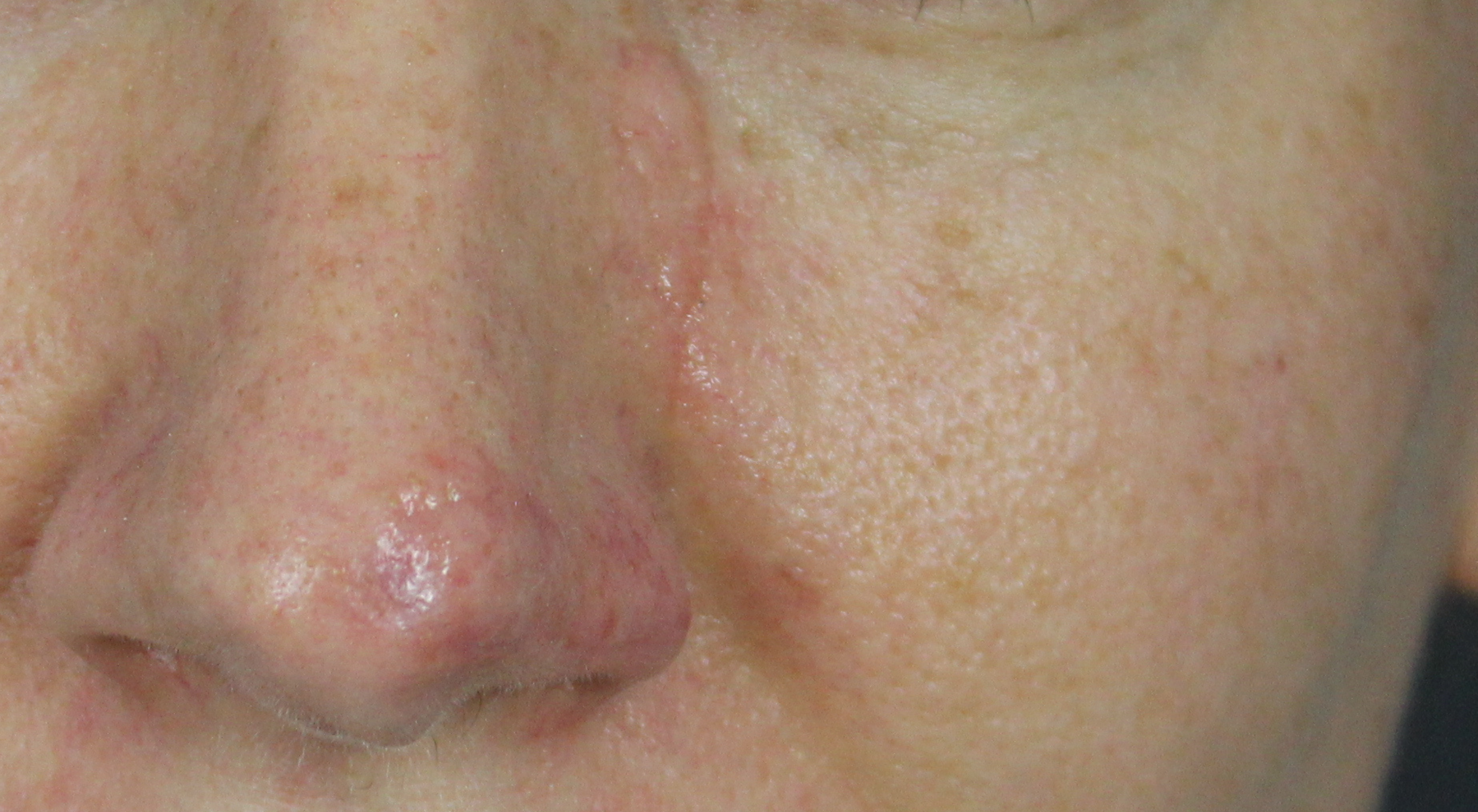 Before Surgical scar revision in Sydney Dermatologist Dr Natasha Cook Alma Hybrid CO2 for scar improvement post mohs surgery face